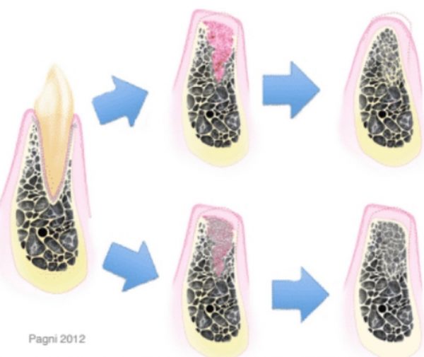 Reducing Alveolar Ridge Resorption after Tooth Extraction ARIADentalEd