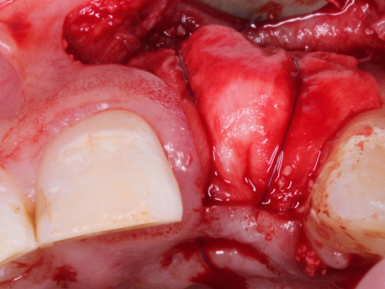 Soft and hard tissue augmentation workshop